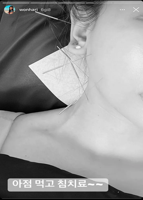 Hari Won tích cực điều trị bệnh. Nữ ca sĩ thực hiện trị liệu châm cứu chữa liệt cơ mặt ở Hàn Quốc và Việt Nam. Ảnh: Vietnamnet