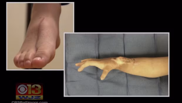 Hiện Lal phải tập vật lý trị liệu mỗi tuần để học cách sử dụng cổ tay, ngón tay và tập luyện sự khéo léo. (Nguồn ảnh: Baltimore