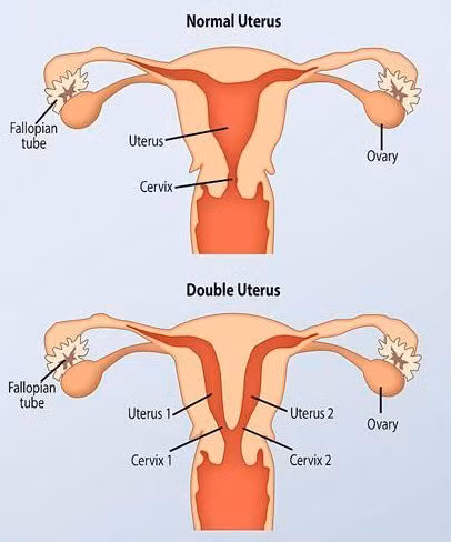 Mặc dù sớm biết mình có tử cung kép và 2 cổ tử cung nhưng đến năm 30 tuổi thì Krista mới biết mình còn có tới 2 vùng kín. 