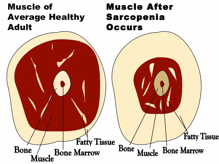 Bệnh nhược cơ: Đây là bệnh khiến các tế bào cơ bị hao mòn dẫn đến mất cơ. Khi giảm cân đột ngột, cơ thể đốt cơ để lấy năng lượng. 
