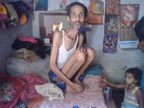 Suy dinh dưỡng: Tác hại của giảm cân nhanh khiến cơ thể không nhận được đủ chất dinh dưỡng dẫn đến bị suy dinh dưỡng, thậm chí có thể dẫn đến tử vong. 