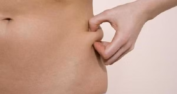 Mỡ sợi: Cũng là mỡ dưới da nhưng mỡ sợi cứng hơn. Mỡ sợi dễ nhận thấy nhất ở vùng xung quanh áo ngực. Mặc quần áo không phù hợp cũng có thể biến mỡ mềm thành mỡ sợi. Mỡ sợi còn khó loại bỏ hơn mỡ mềm vì xung quanh các tế bào mỡ đã tồn tại những dạng sợi.