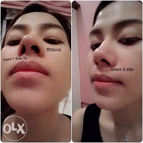 Một điều đáng lo ngại khác là nếu không may móc nâng mũi bị tuột khỏi vị trí khi vẫn còn trong mũi thì khả năng sẽ bị trôi ngược vào bên trong khoang mũi. (Nguồn ảnh: Harpersbazaar, OLX)