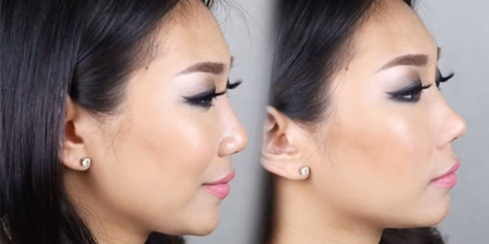 Giáo sư Richard Harvey, chủ nhiệm khoa mũi họng thuộc Đại học New South Wales (Australia) cho rằng sử dụng dụng cụ nâng mũi sẽ gây áp lực lên sụn mũi, làm giãn và biến dạng lớp màng trong của mũi. 