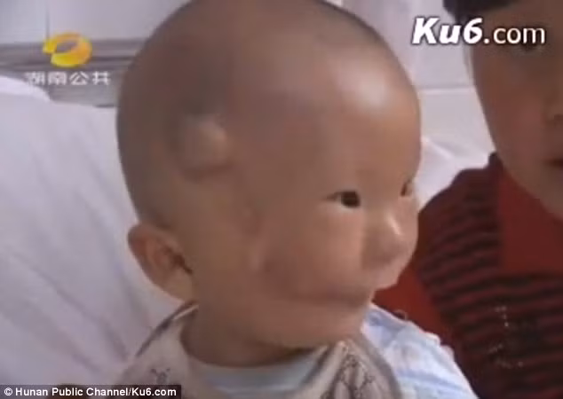 Bác sĩ đánh giá dị tật của bé Huikang là cực hiếm và rất nghiêm trọng, không chỉ các tế bào mềm bị hư hại, xô lệch mà xương thái dương, xương má, xương bướm và hàm trên đều bị ảnh hưởng. Với số tiền quyên góp được lên tới hơn 1 tỉ đồng, năm 2016, bé Huikang đã được phẫu thuật 2 lần nhưng phải 10 năm tới mới xác định được xương mặt cậu bé có thể phát triển bình thường được không. 