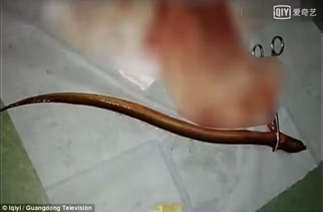 Ban đầu, ông Liu nói vô tình bị lươn chui vào hậu môn, nhưng sau mới thừa nhận đã tự cho lươn vào hậu môn chữa táo bón sau khi tìm hiểu và biết rằng nếu cho một loại cá nhỏ, dài vào bụng thì có thể bôi trơn đường ruột và đi vệ sinh bình thường. Nhưng người đàn ông này không hề biết con lươn sống có thể trườn lên phần ruột phía trên, đục thủng ruột và gây nên một mớ hỗn độn bên trong khoang bụng. (ảnh: asiaone)