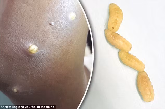 Kinh hãi phát hiện tay bị giòi ăn sau chuyến du lịch Kinh hai phat hien tay bi gioi an sau chuyen du lich