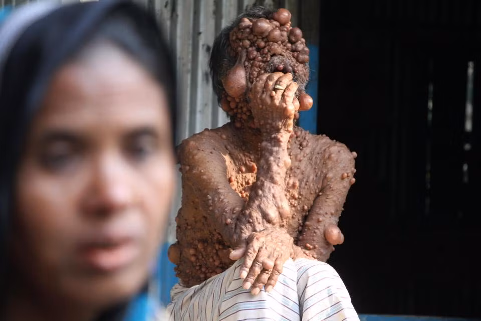 Ông bố 3 con này hiện đang sống ở Shajadpur, phía Bắc Bangladesh một cách rất chật vật vì thường xuyên bị ngứa, toàn cơ thể nặng nề. Ngoại hình kỳ dị của ông khiến đứa con trai 12 tuổi của ông không dám nhìn mặt bố mình. 