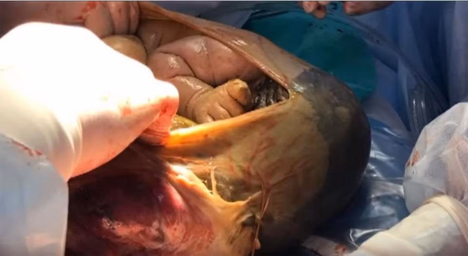 Trong quá trình mang thai, vì lý do tín ngưỡng, bà mẹ 31 tuổi này đã tránh mọi can thiệp của y học, không khám thai, không uống thuốc. Sản phụ mang thai lần đầu này cho biết cô chắc chắn con mình vẫn khỏe vì thấy em bé chuyển động trong bụng. Vì thế vấn đề chỉ được phát hiện vào phút chót khi bà mẹ này đến ngày sinh nở vẫn không chuyển dạ.