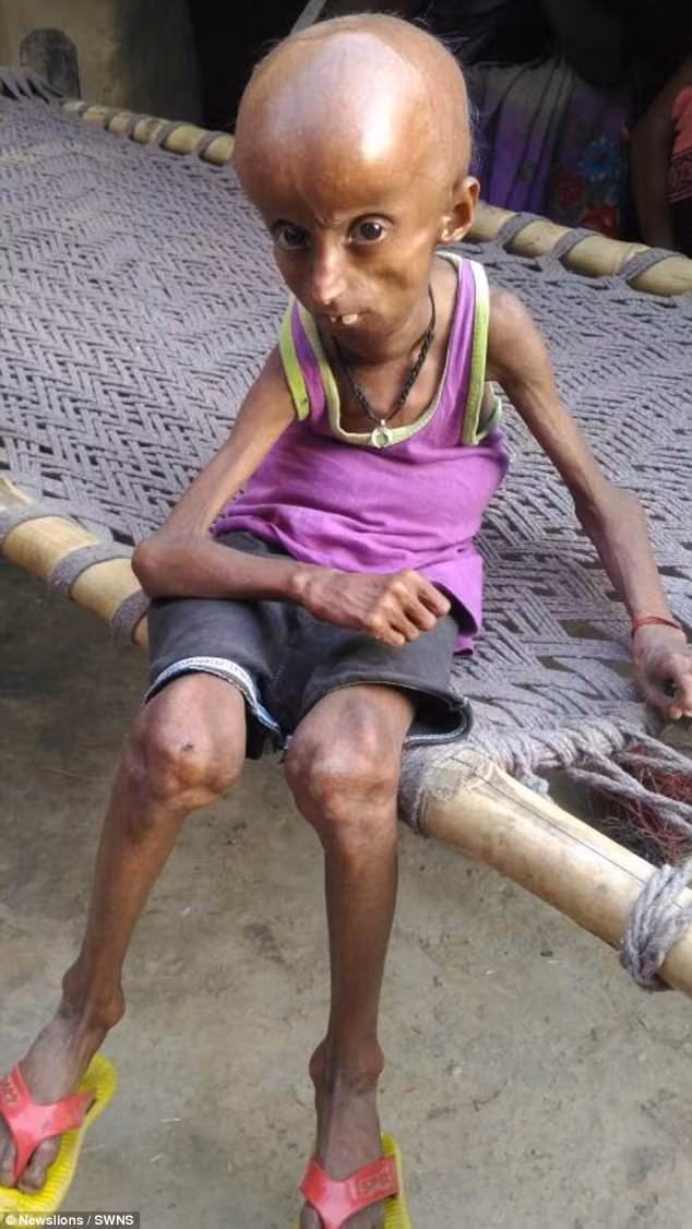 Rupesh Kumar, sinh ra ở Hanumanganj, Ấn Độ đang già đi với tốc độ nhanh gấp 8 lần người bình thường vì bị mắc một căn bệnh lão hóa kỳ lạ. Bộ dạng già nua của Rupesh gây hiếu kỳ đến nỗi bố mẹ Rupesh từng được mời nhận một khoản tiền để bán con mình cho rạp xiếc.