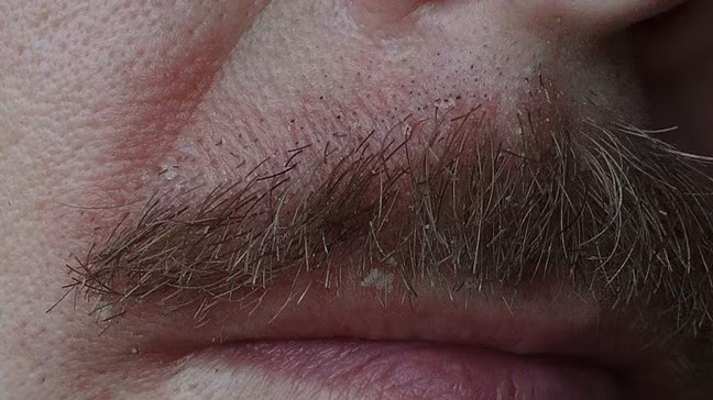 Một dạng viêm da đầu khác là viêm da tiết dầu, đặc trưng là xuất hiện các mảng màu trắng hoặc vàng không chỉ trên da đầu mà còn trên lông mày. Dù ít nhưng viêm da đầu dạng này có thể gây rụng tóc. Nguyên nhân là do tuyến bã nhỡn bị dính vào nang tóc tạo thành bã nhờn, gây nấm khiến tóc không mọc được. (Ảnh: Healthline) 