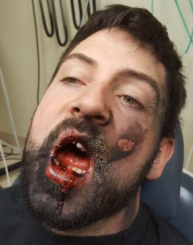 Nạn nhân xui xẻo là Andrew Hall người Mỹ lúc đó đang hút thuốc lá điện tử và ngậm cây thuốc lá trong miệng. Ngoài việc bị mất 7 chiếc răng thì Andrew còn bị các mảnh nhựa găm vào mặt và bỏng độ 2. 