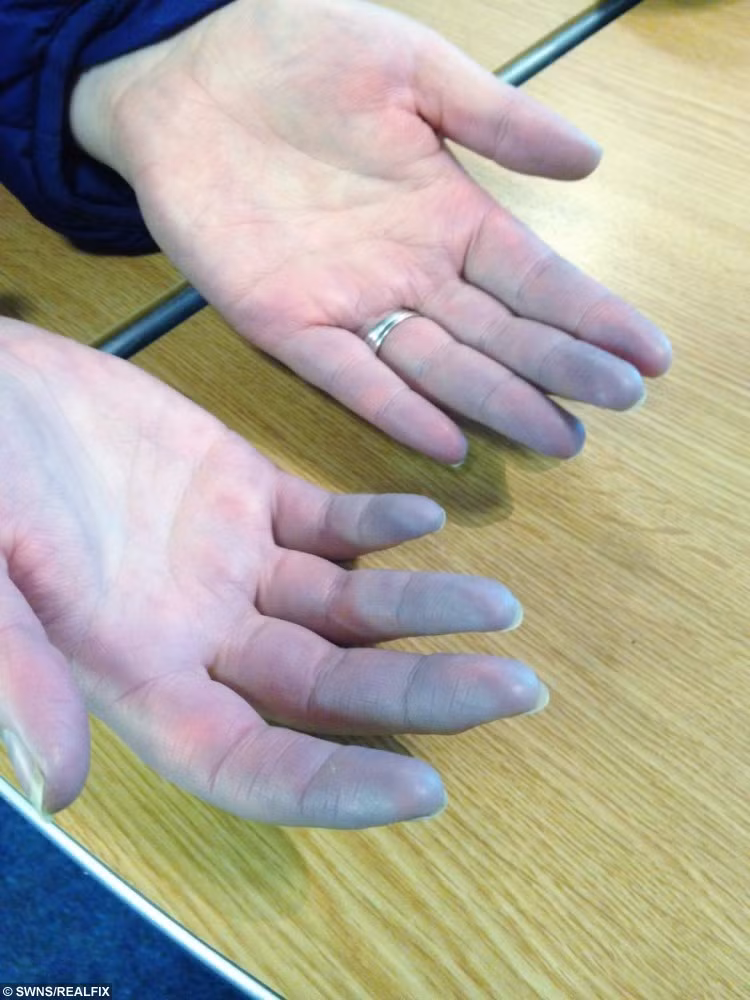 Cô được chẩn đoán mắc hội chứng này từ năm 15 tuổi, bác sĩ dự đoán bệnh sẽ khỏi khi hết tuổi trưởng thành và cho cô uống một loại thuốc có tác dụng thông mạch máu. Tuy nhiên, thuốc không có tác dụng vì thực ra bệnh lạnh tay chân mà cô Chelsea mắc phải là do một nguyên nhân khác và đến năm 23 tuổi mới phát hiện ra.