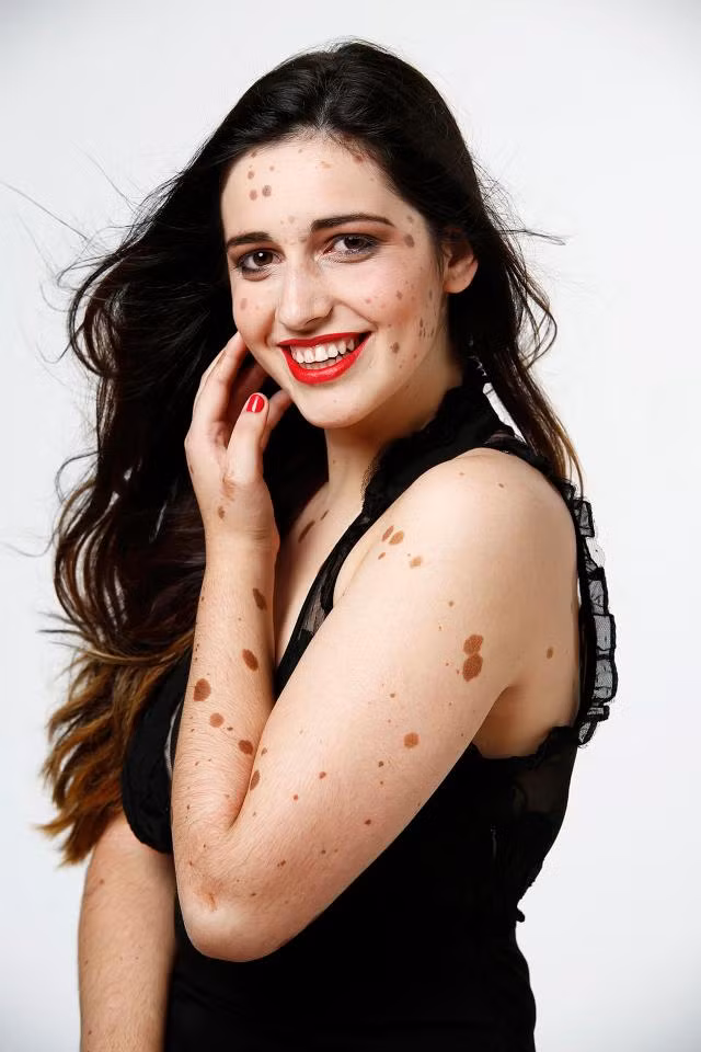 Một nữ sinh bị gắn với những biệt danh rất tàn nhẫn như “chó đốm” hay “người ngoài hành tinh” vì nốt ruồi mọc đầy người đã vượt qua mọi lời trêu ghẹo để trở thành một người mẫu.