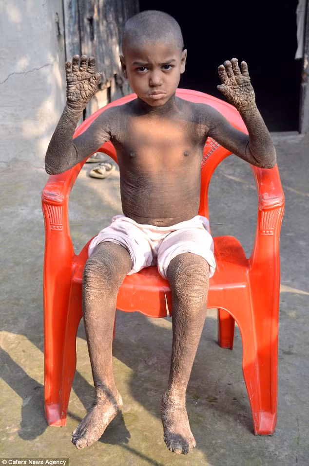 Mặc dù không có thuốc đặc trị chữa khỏi nhưng cậu bé Mehdi Hassan người Bangladesh 8 tuổi mắc phải căn bệnh hóa đá đã hồi phục một cách kỳ diệu.