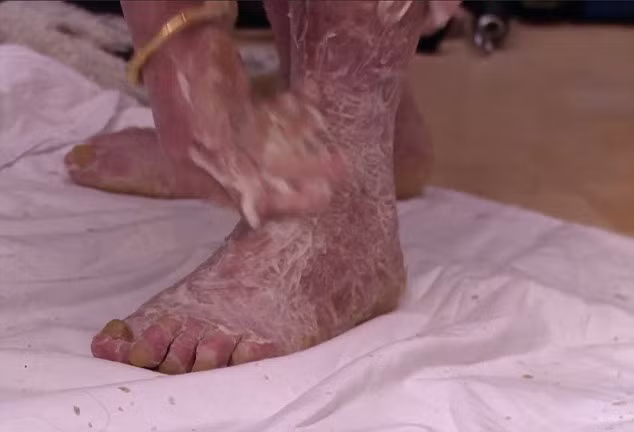 Giờ đây đã 33 tuổi, cô Nelly trở thành người sống được lâu nhất với căn bệnh đe dọa tính mạng này – hay còn gọi là bệnh vảy cá Harlequin Ichthyosis. 