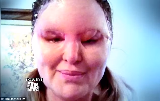 Sau 3 tháng, cô Carol để ý thấy mặt mình bắt đầu nở ra và da dính vào nhau. Khi nhìn vào gương, cô không còn nhận ra mình nữa. 