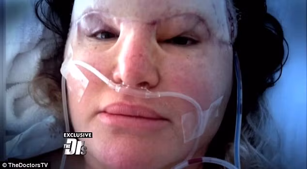 Lúc này vùng da trán của cô sưng vù lên khiến cô không mở được mắt và phải dán băng dính để giữ thì mới thấy đường đi lại. 