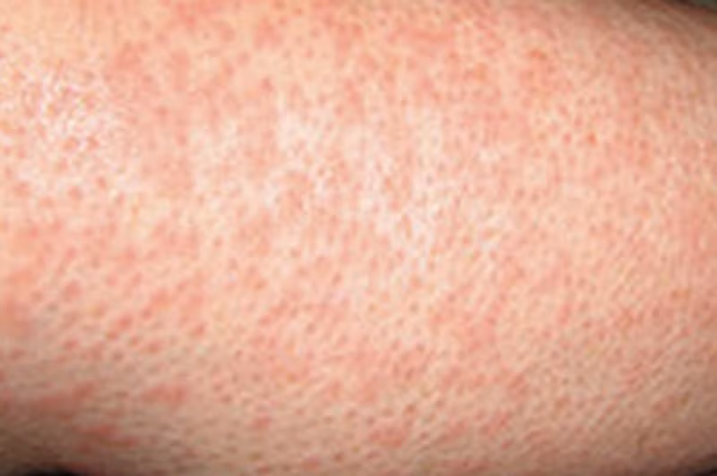 Phát ban: Đây chính là các nốt rôm sảy xuất hiện trên các nếp gấp của da hoặc những vùng không mấy thông thoáng trên cơ thể. Triệu chứng này chủ yếu xuất hiện ở trẻ sơ sinh, trẻ nhỏ, người già hoặc người béo phì. Nguyên nhân là do các tuyến mồ hôi bị tắc khiến mồ hôi không thể thoát lên bề mặt da và gây viêm. Cách điều trị là dùng kem có chứa calamine (quặng kẽm), nếu bị viêm tuyến mồ hôi thì cần dùng kháng sinh. (Ảnh: rashresource) 