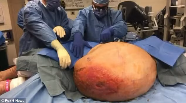 Trong ca phẫu thuật kéo dài 5 giờ, các bác sĩ đã cẩn thận cắt bỏ khối u khổng lồ nặng 50kg cùng với khoảng 15kg da thừa cho bệnh nhân. 