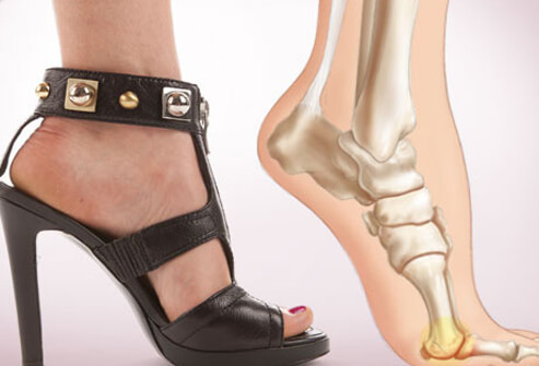 Giày cao gót buộc chân bị đặt trong tư thế đệm lòng bàn chân bị đè căng. Đây là điểm tiếp giáp giữa khối xương bàn chân với xương hạt vừng và xương ngón chân và là khớp nối vô cùng quan trọng. Khi bị áp lực, những xương này và những dây thần kinh xung quanh nó sẽ sưng lên. Xương chân bị đè trong một thời gian dài sẽ bị rạn. 