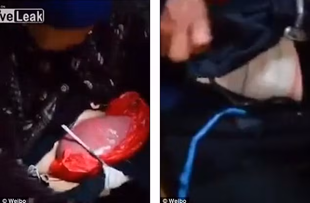 Mặc dù được khuyên nên phẫu thuật lại nhưng vì kinh tế quá khó khăn, cụ đành chấp nhận để ruột xổ ra ngoài và dùng một chiếc túi nylong để đựng. Khi cụ Lan mở túi ra, bên trong là cả một khối ruột kèm dịch ruột. Ngoài ra cụ luôn mang theo một chiếc túi bên mình để đựng chất thải. 