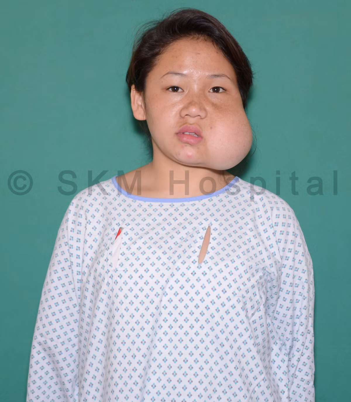 Từng đấy năm sống trong đau khổ cả về thể chất và tinh thần, Bina không dám soi gương và thường cảm thấy ghen tị với các bạn bè cùng lứa. Mỗi khi ra đường để tránh bị người khác soi mói, cô phải lấy khăn che mặt. 