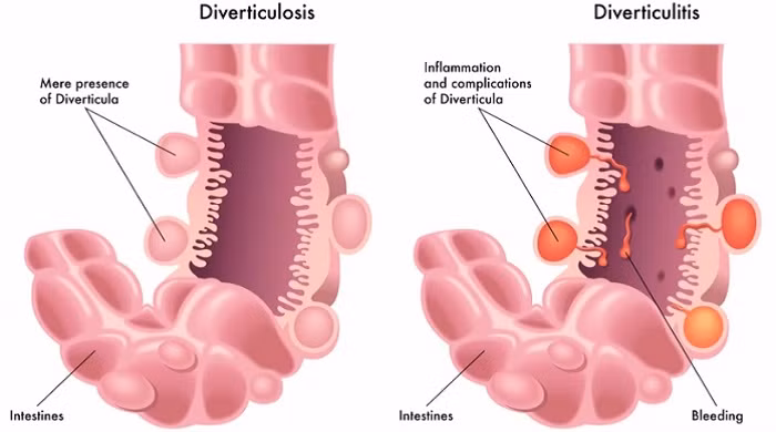 Bệnh túi thừa: Rất nhiều phụ nữ bị đau bụng dưới và cho rằng đó là điều tự nhiên trong sản khoa. Nhưng hóa ra nhiều chị em bị bệnh túi thừa đại tràng nên không biết mình bị đau từ đường tiêu hóa chứ không phải từ các cơ quan sinh sản. Đau do túi thừa là đau ở bên trong đường tiêu hóa kèm theo sốt hoặc nôn nữa. Nếu bị nhẹ chỉ cần nghỉ ngơi, ăn kiêng và uống kháng sinh. Nếu bị nặng có thể cần phải mổ. 