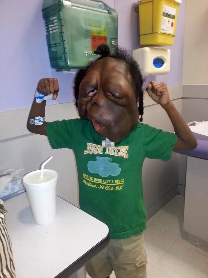 Amare Stover bị gọi là “quái vật” một cách đầy ác ý vì bẩm sinh đã mang khối u sợi thần kinh loại 1 (NF1). Dạng u này có thể phát triển ở bất kỳ đâu trên cơ thể. 