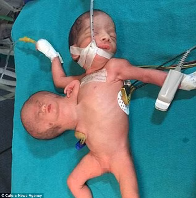 Choang vang ca sinh doi ky sinh ky la nhat the gioi-Hinh-2