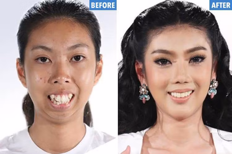 Một thiếu nữ sinh ra đã không có cằm đã lột xác trở thành hotgirl Thái Lan sau phẫu thuật thẩm mỹ. Nếu chỉ nhìn vào ảnh mà không biết đến câu chuyện của cô ấy thì khó ai nhận ra đây là hai tấm ảnh của cùng một người.