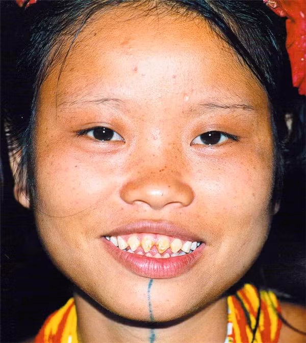 Răng mài nhọn là một trong những tiêu chuẩn của cái đẹp.