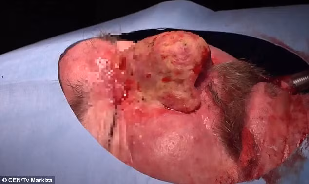 Ca phẫu thuật diễn ra suôn sẻ, không gặp phải sự cố nào và ngay lập tức ông Tibor đã có một cái mũi khác. Bác sĩ Igor Homola, người đã phẫu thuật cho ông Tibor cho biết cái mũi củ tỏi không chỉ ảnh hưởng đến thẩm mỹ mà tình trạng viêm sưng còn có thể gây mất thị lực. (Nguồn ảnh: DM)