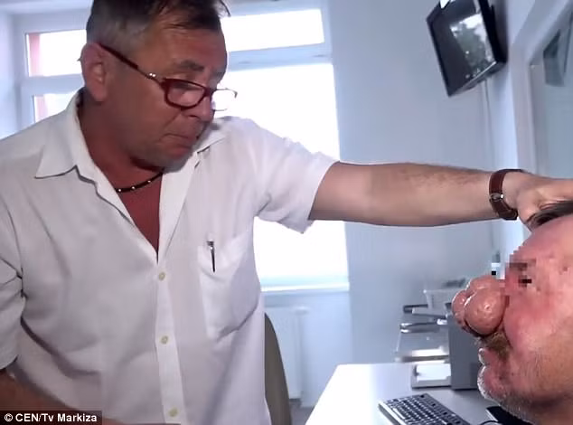 Sau khi được gia đình động viên, ông Tibor mới có đủ dũng cảm đi mổ. Các bác sĩ đã tạo cho ông một cái mũi mới để ông Tibor có thể sống cuộc sống bình thường. 