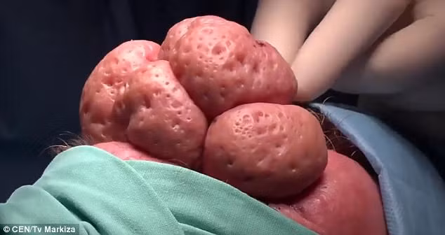 Ông Tibor bị một căn bệnh mang tên “mũi sư tử” khiến mũi phình to ra và đỏ ửng. Nguyên nhân thường là do bệnh trứng cá đỏ không được chữa trị. 