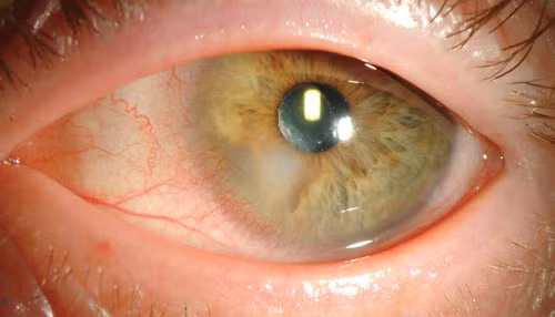 Viêm mõng mạc do keratitis có thể chuyển thành dạng u nhọt và nếu không được điều trị kịp thời thì người bệnh sẽ bị mù. 