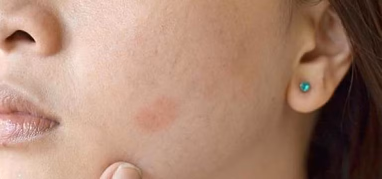 Da có bị kích ứng không? Khi có một làn da khỏe mạnh, bạn sẽ chẳng cảm thấy gì. Ngược lại, nếu thấy bị ngứa, châm chích hoặc đau thì đó là những dấu hiệu cho thấy da đang dị ứng, bị côn trùng đốt hoặc bị các bệnh da liễu như eczema, vảy nến, lupus…(Ảnh: Enchulatuflog)