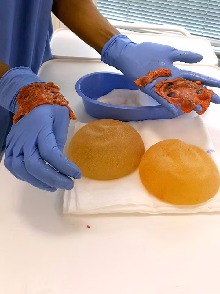 Lúc này cô mới biết chắc chắn 2 khối silicon tuy chưa bị rách nhưng đã xẹp, lớp vỏ bên ngoài đã sắp hỏng, nếu để lâu hơn nữa sẽ bị bục và cô có thể sẽ không giữ được tính mạng. Loại silicon mà cô bơm vào ngực từ năm 2002 nay đã bị cấm sử dụng tại Anh vì lý do an toàn. 