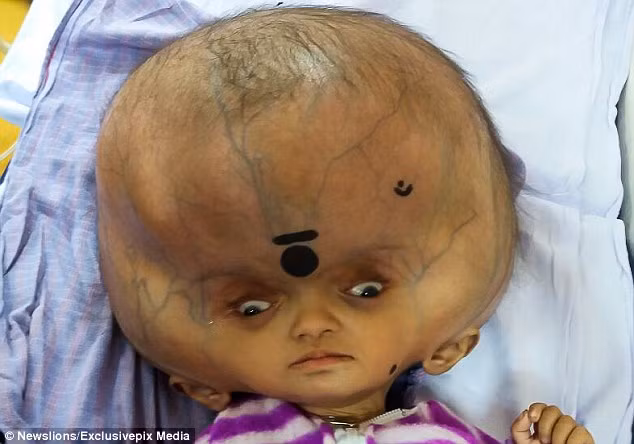 Ca phẫu thuật làm giảm áp lực lên não đối với với bé trai người Ấn Độ có cái đầu to nhất thế giới đã diễn ra thành công.