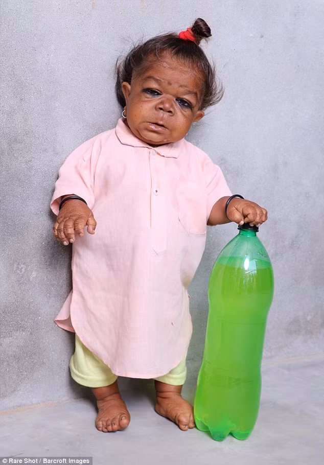 Một người tí hon Ấn Độ đang được tôn thờ là hiện thân của thần Hindu vì mắc một căn bệnh bí ẩn khiến người này chỉ cao có 58cm. 