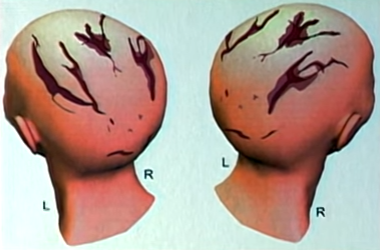 Kết quả khám nghiệm tử thi cho thấy 7 vết nứt xuất hiện trên đỉnh đầu Kathleen. Một cú ngã cầu thang không thể gây nên nhiều vết thương như vậy.