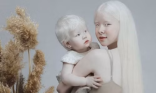 Diện mạo khác lạ của hai chị em người Kazakhstan bị bạch tạng.