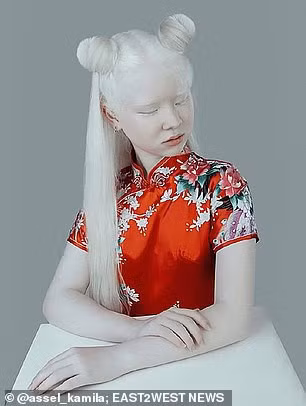 Aiman Sarkitova (38 tuổi), mẹ của Asel và Kamila chia sẻ rằng lúc mới sinh Asel, chị và mọi người trong gia đình đều vô cùng sốc vì cô bé khác biệt so với các thành viên còn lại trong nhà.