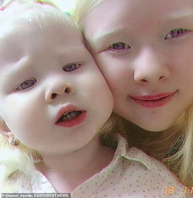 Không những vậy, sau khi cô em gái tên Kamila ra đời và cũng bị bạch tạng càng khiến sự quan tâm dành cho hai chị em gia tăng.