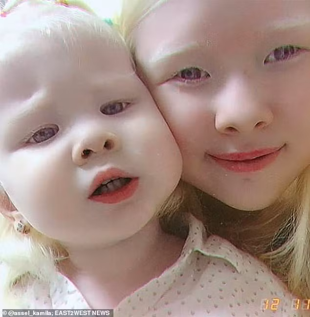 Không những vậy, sau khi cô em gái tên Kamila ra đời và cũng bị bạch tạng càng khiến sự quan tâm dành cho hai chị em gia tăng.