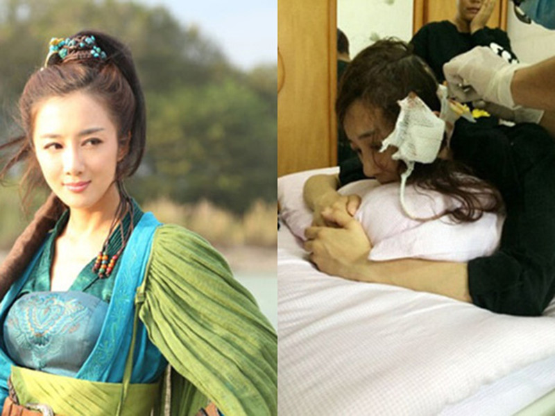 Năm 2014, Diệp Tuyền mang theo vài chú chó đến phim trường, trong đó có một chú chó Alaska đã tấn công Lý Y Hiểu khiến cô phải khâu đến 20 mũi ở gáy và tai.