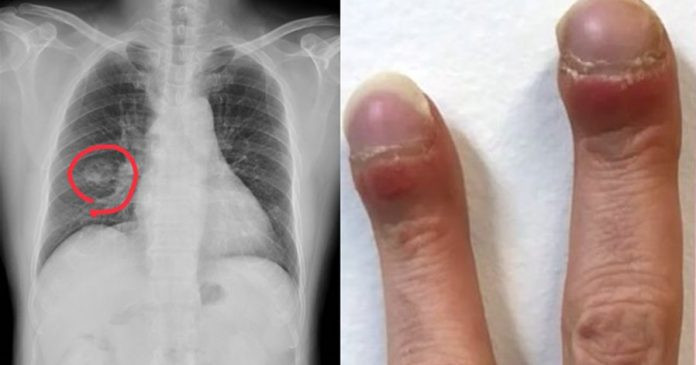 Tren tay co 2 bieu hien la, di kham phat hien dieu rung ron