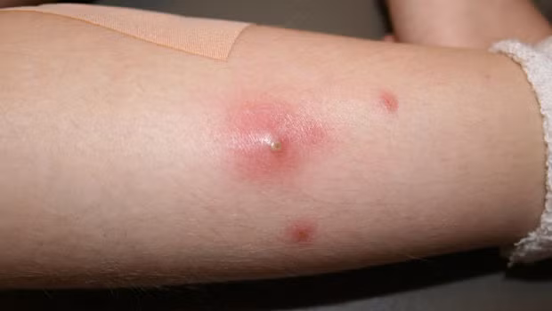 Meo dap banh mi tri mun nhot hieu qua bat ngo