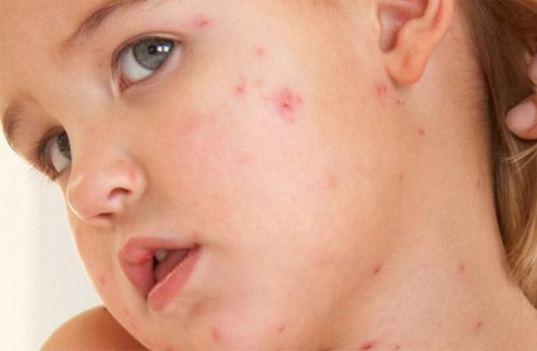 Người bị sởi nên ăn đa dạng các loại thực phẩm mỗi ngày, trung bình từ 15 – 20 loại thực phẩm/ngày. Ảnh: onecmscdn.