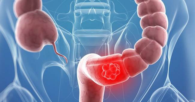 Bên cạnh đó, khi bị rối loạn tiêu hóa kéo dài bạn cũng cần hết sức cảnh giác. Ảnh: cih.